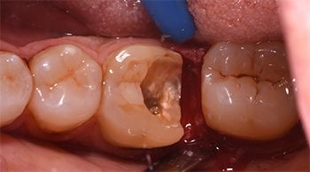 Allungamento di corona clinica