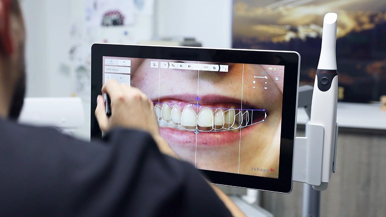 Trsion move smile designing with patient