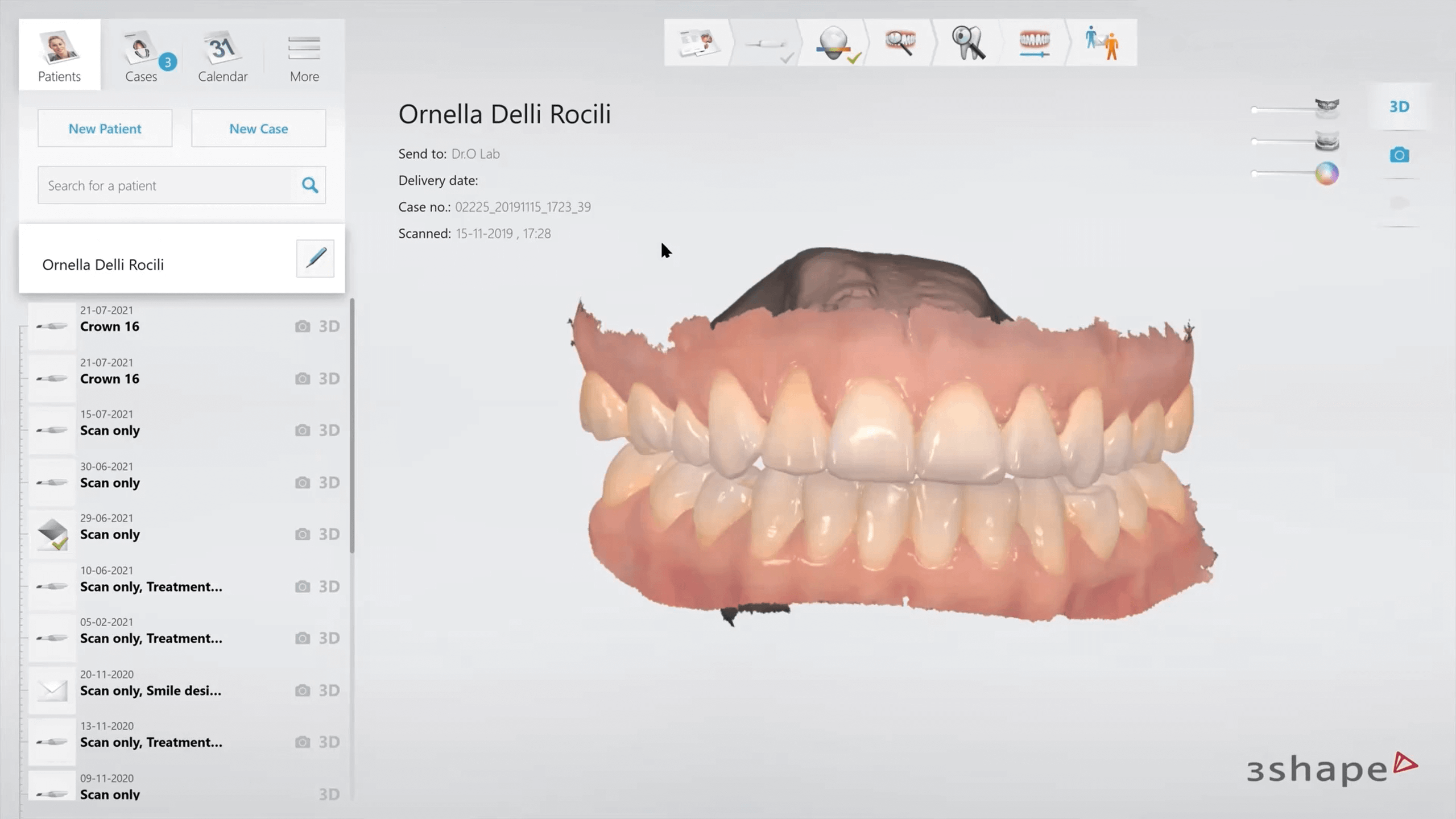 Teeth scan in TRIOS patient Monitoring
