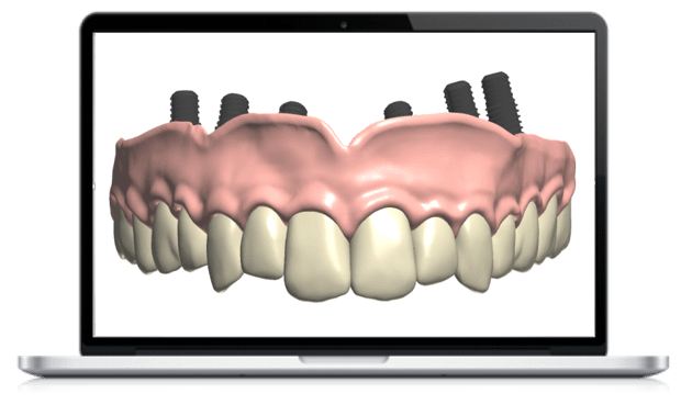 Dental System Implant Bridge