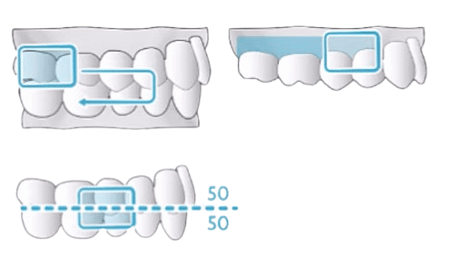 Bite scanning with TRIOS