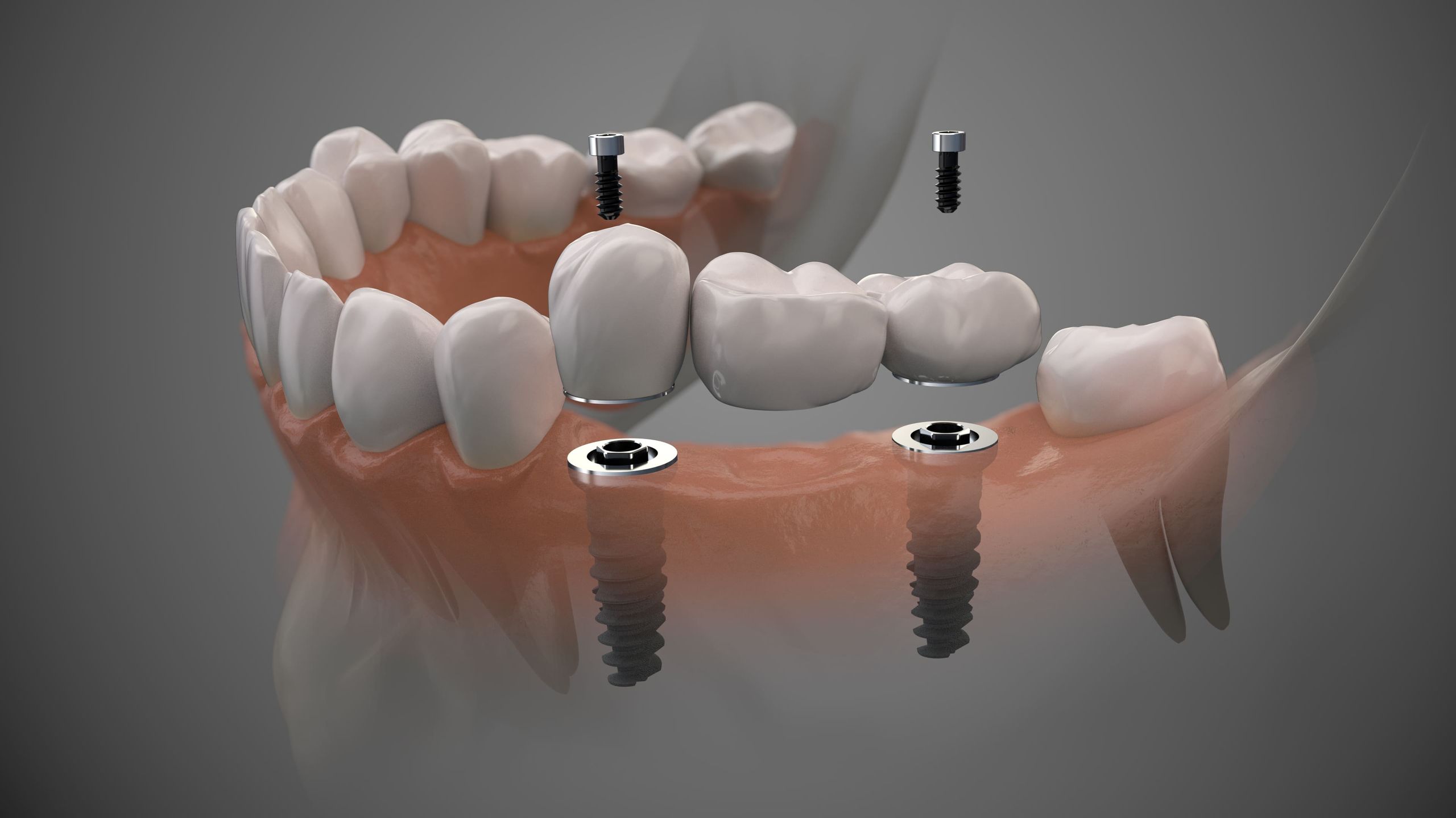 Implant surgical guide