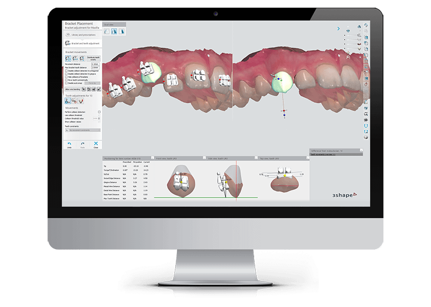 3shape Bracketbibliotheken Von Den Herstellern Bereitgestellt