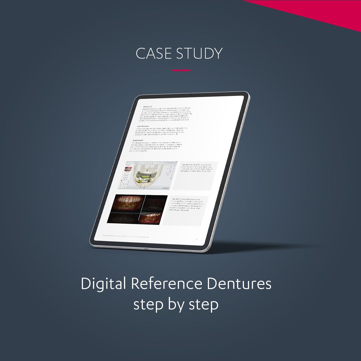 Digital Reference Denture technique step-by-step| Case study