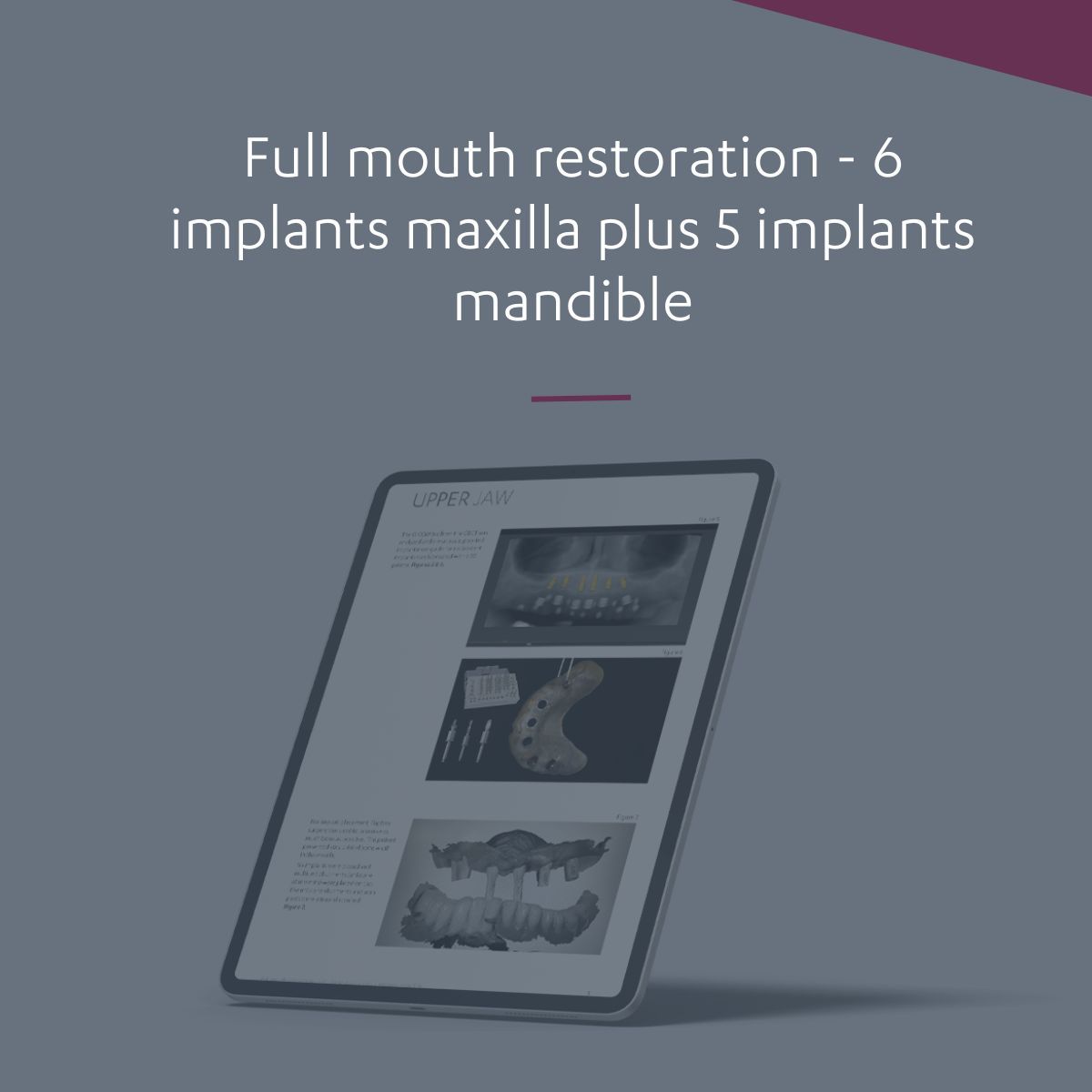 Full mouth restoration 6 implants maxilla plus 5 implants mandible