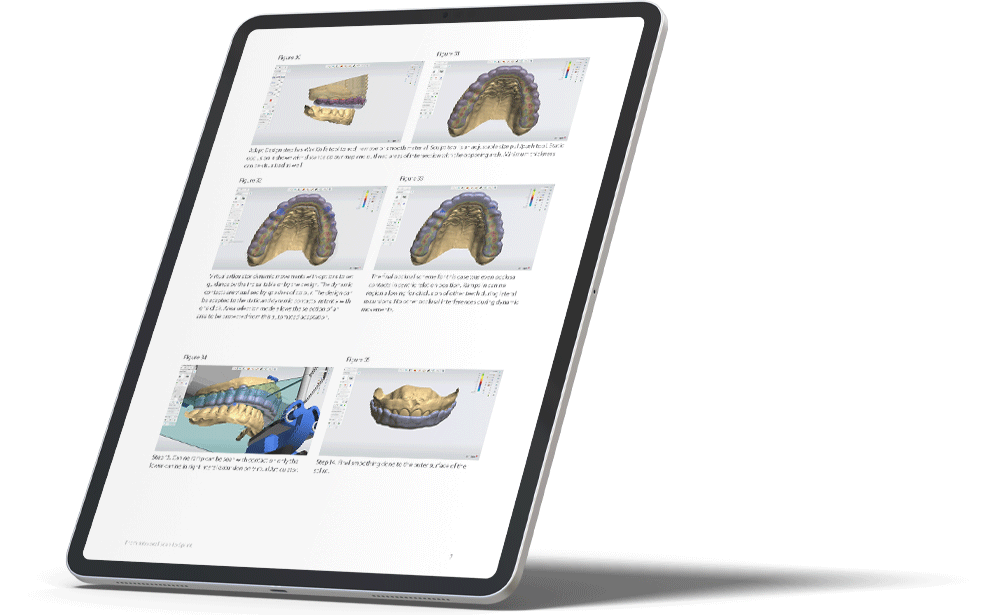 From Intraoral scanning to splint