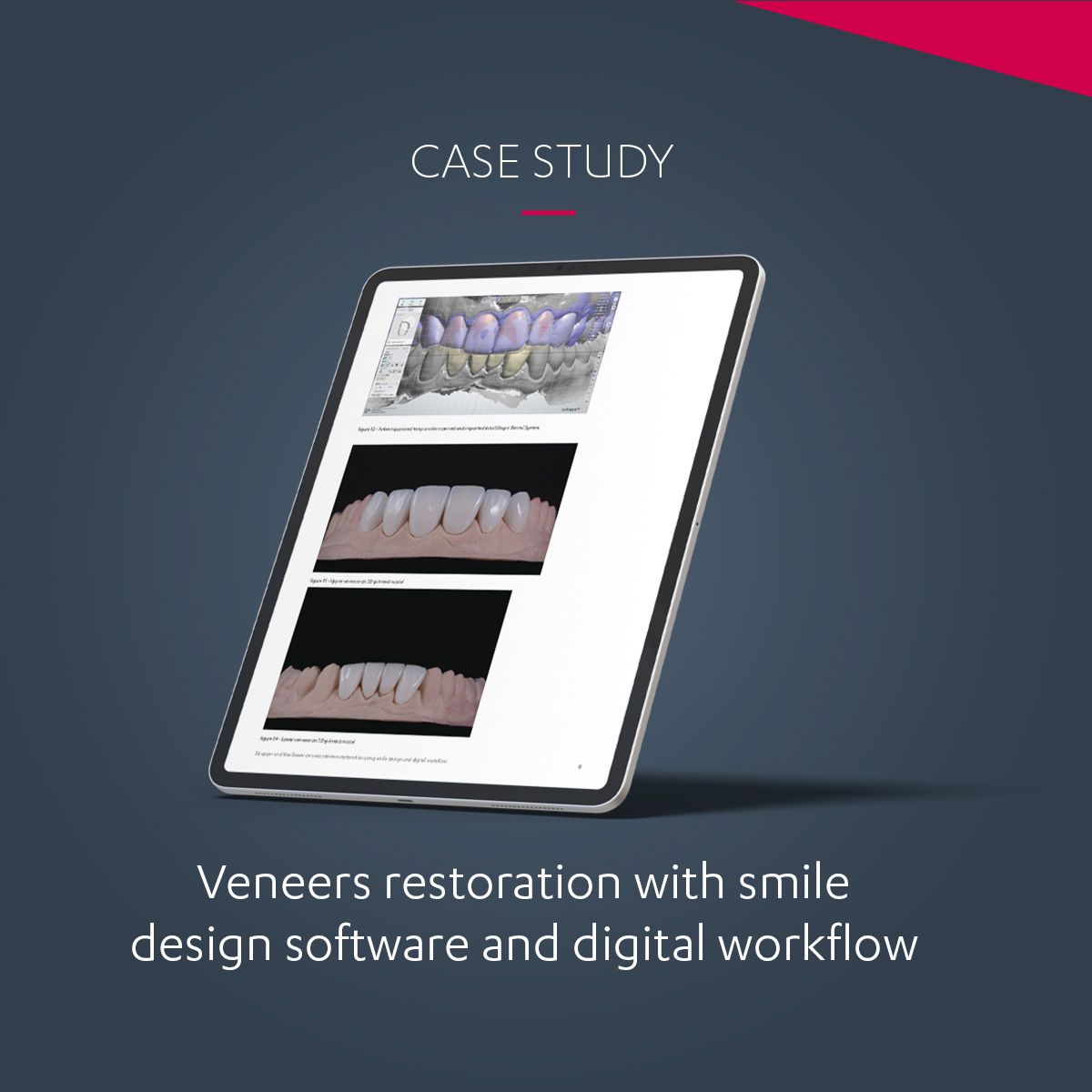 Digital Smile Design - Case Study 3Shape