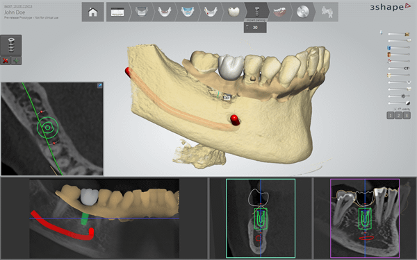 3Shape implant studio dental software