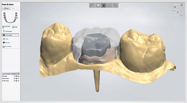 3Shape patented Scan Posts