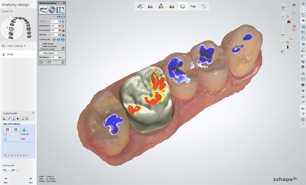 Adapt the design to dynamic occlusion