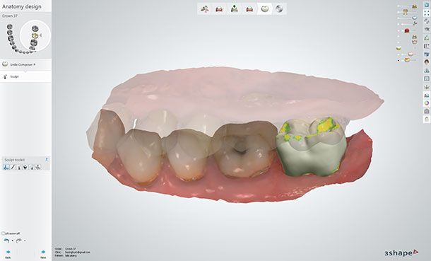 Designing the model-free crown in Dental System