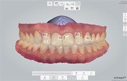 TRIOS Teeth Shade Measurement