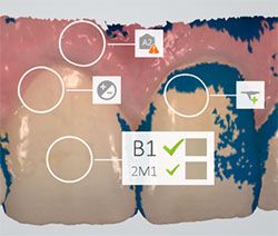 3Shape TRIOS automatically measures snades