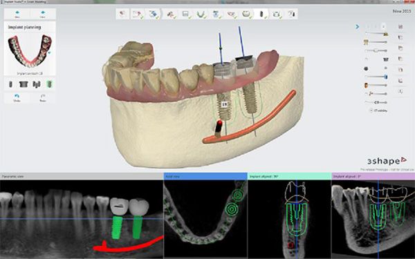 Implant Studio and Orthodontic software get upgrades