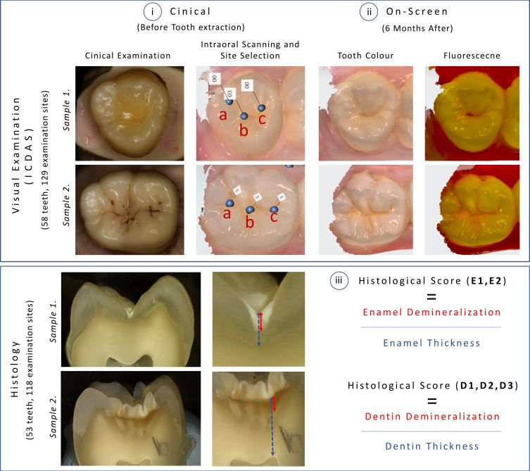 Caries detection