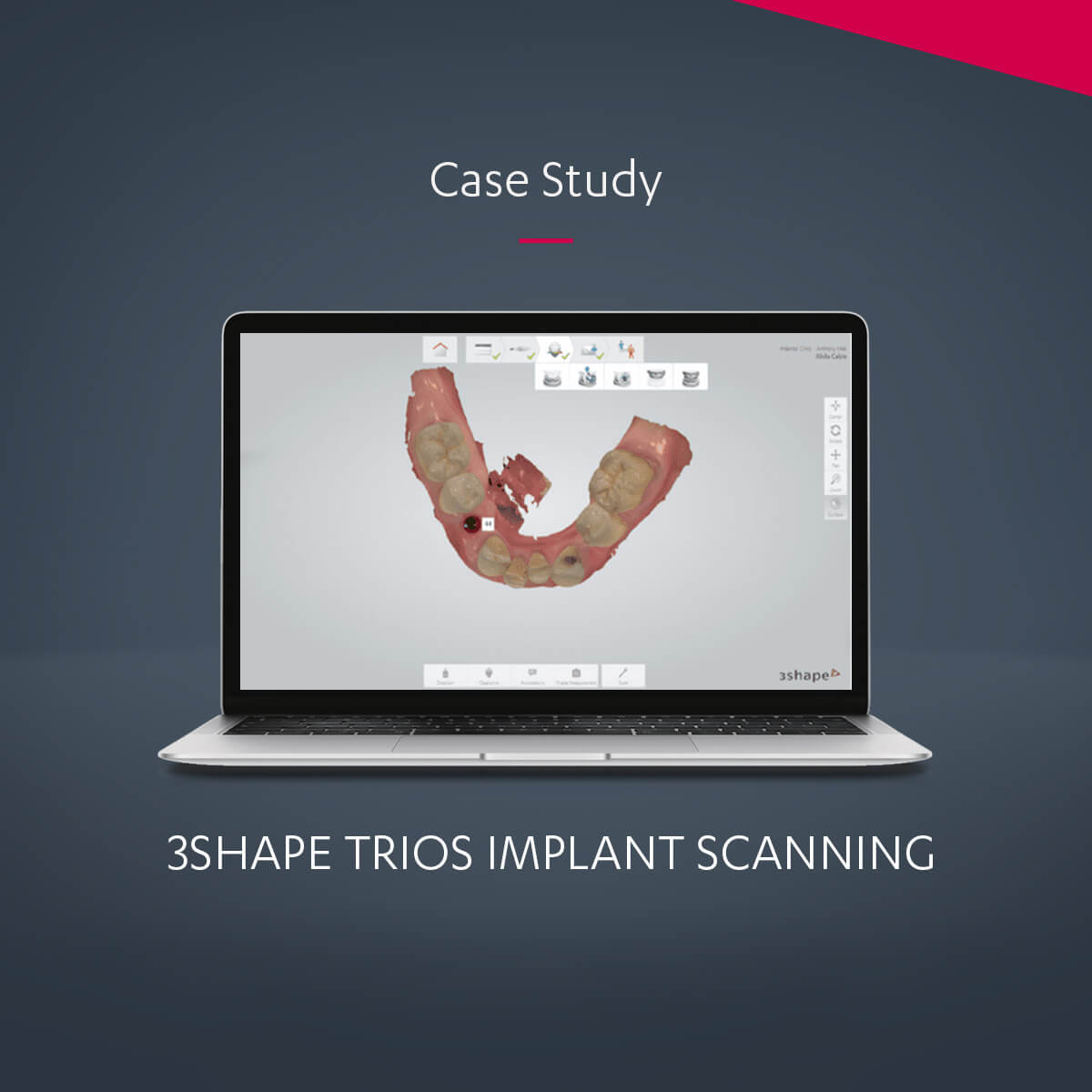 6 crowns prepared and placed in 2 hours with 3Shape Automate | Case study
