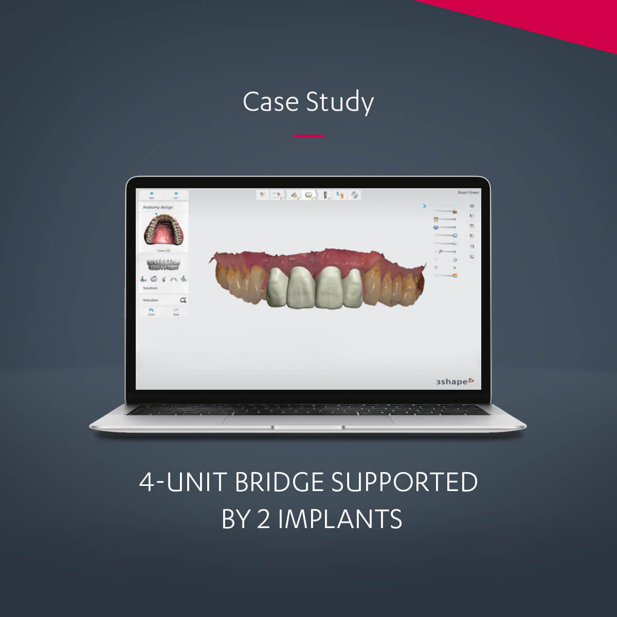 4unit bridge supported by 2 implants using digital workflow Case study