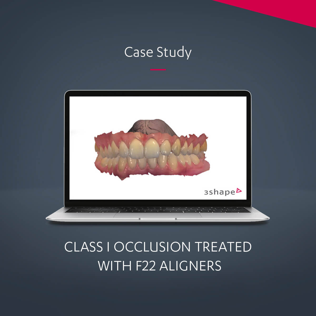 Class 1 occlusion treated with F22 Aligners Case Study