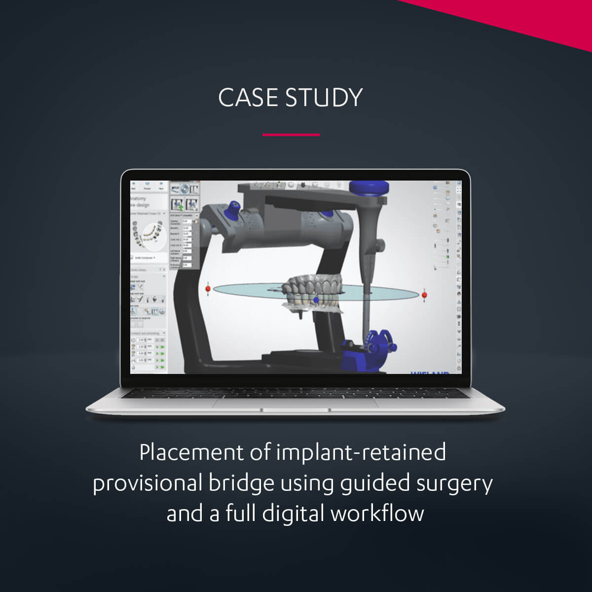 Placement of implantretained provisional bridge using guided surgery