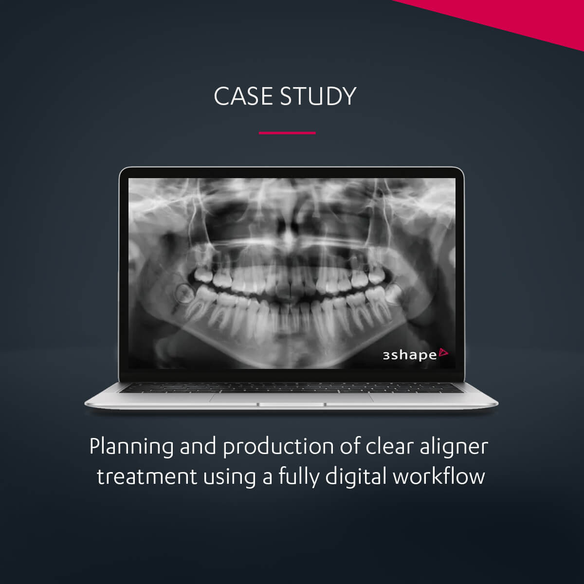 Conception et fabrication « in office » des gouttières orthodontiques  thermoformées à l'aide du logiciel 3Shape Clear Aligner Studio –  L'Information Dentaire