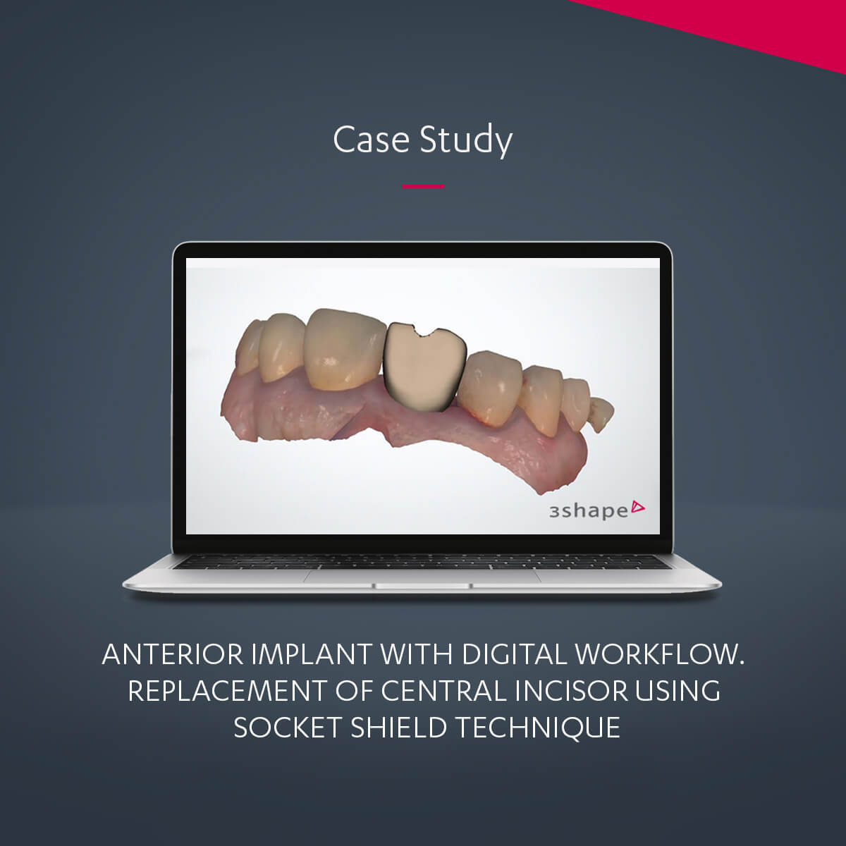 Replacement Of Central Incisor | Case Study