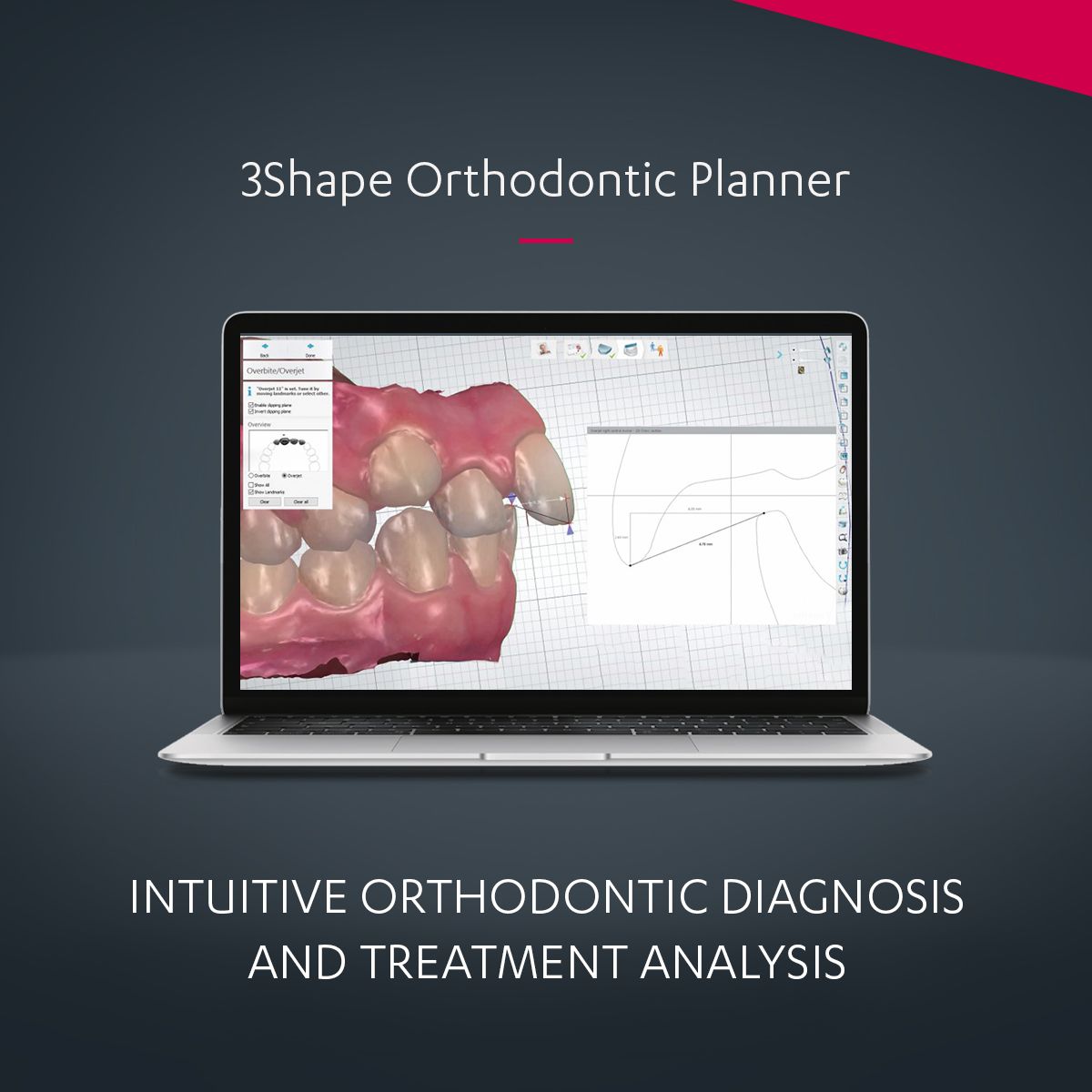 3Shape Orthodontic Planner - Intuitive Diagnosis & Treatment Analysis