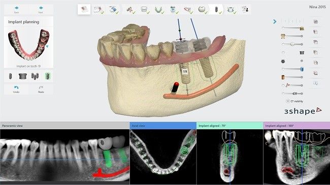 CT/Cone Beam CT imaging with Implant Studio software