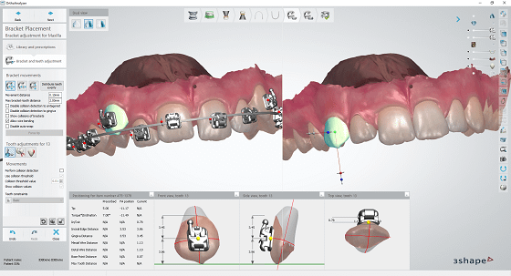 3Shape Bracket Placement module