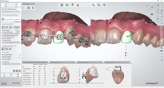 3Shape Indirect Bonding application for dentists