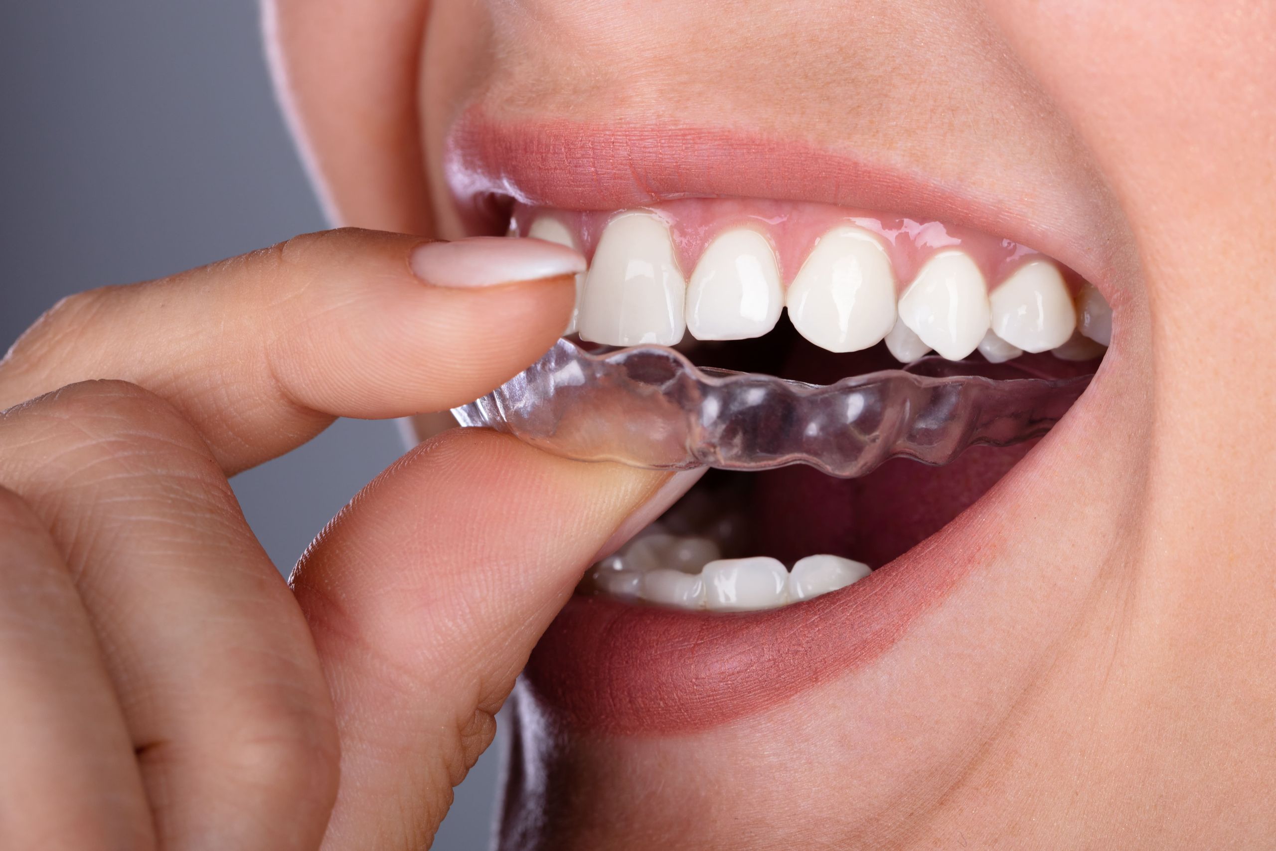 Invisible teeth aligners in orthodontics: how do they work?