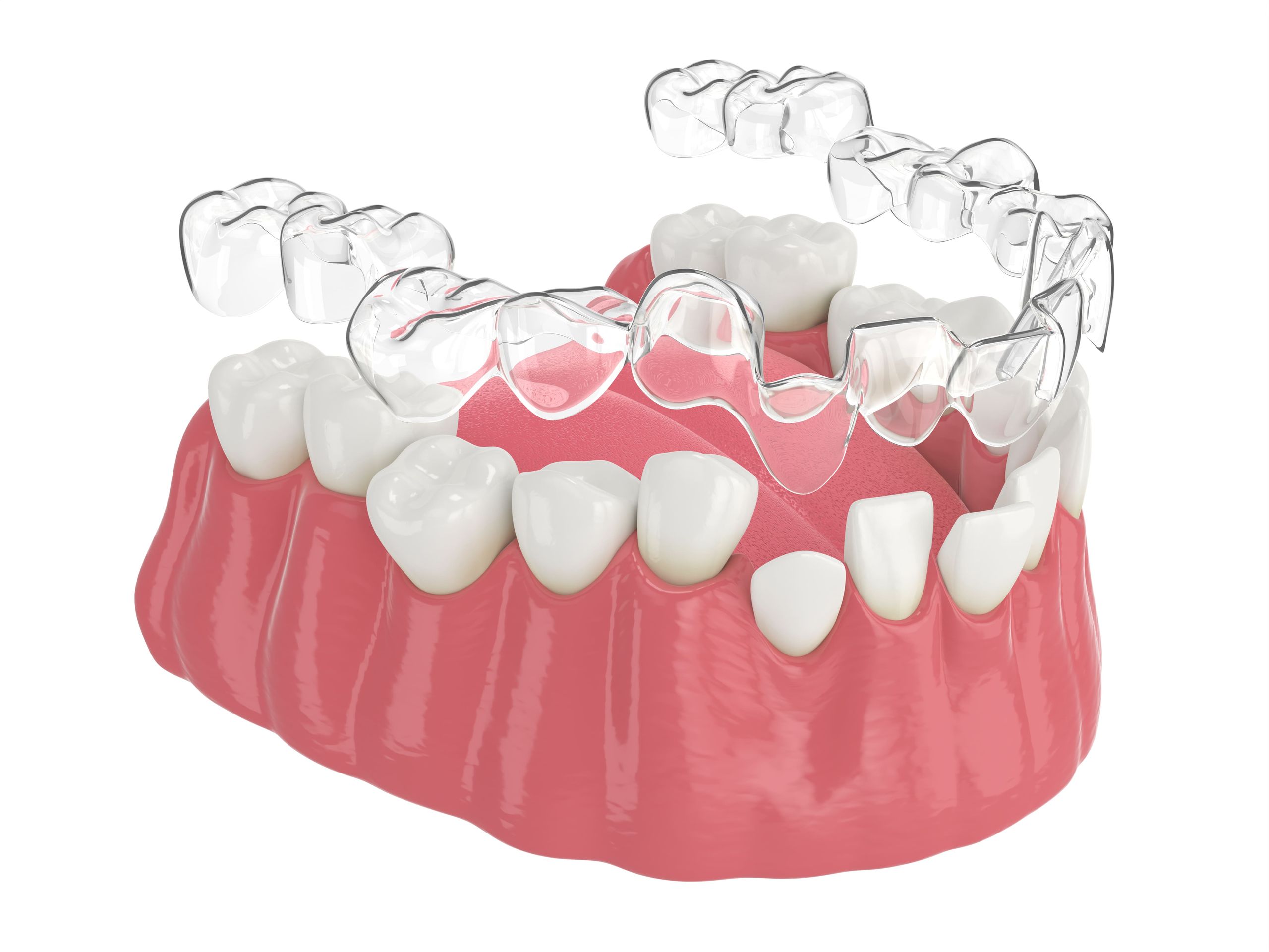 Invisible teeth aligners in orthodontics: how do they work?