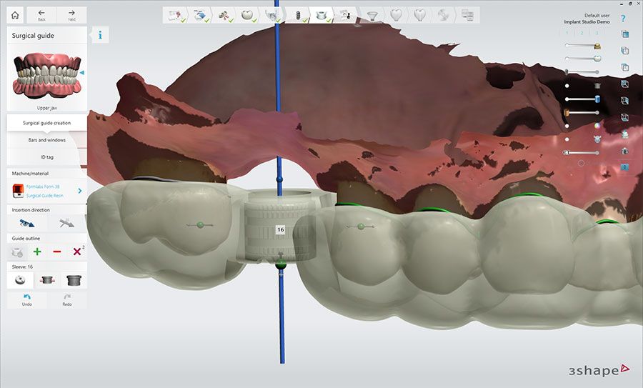 3Shape Implant Studio — Software Improvement and Changes