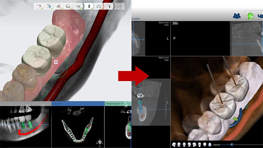 3Shape Implant Studio — Software Improvement and Changes