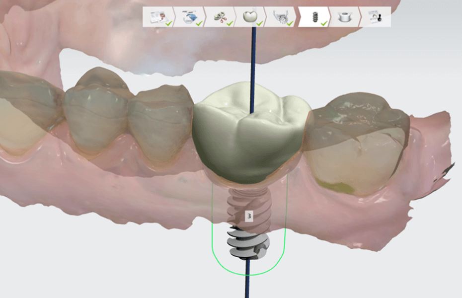 AI segmentation of the jaw in Implant Studio