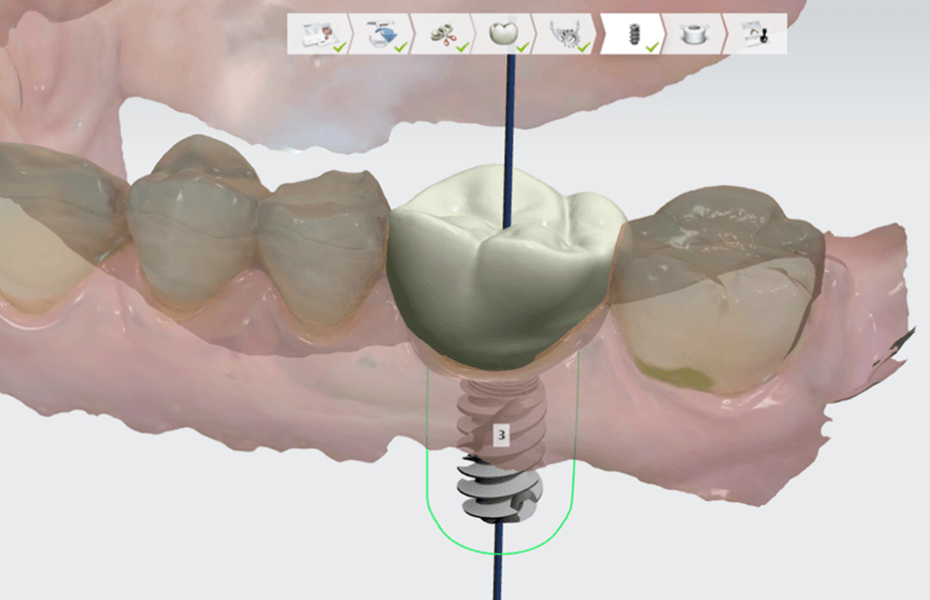 3Shape Implant Studio — Software Improvement and Changes