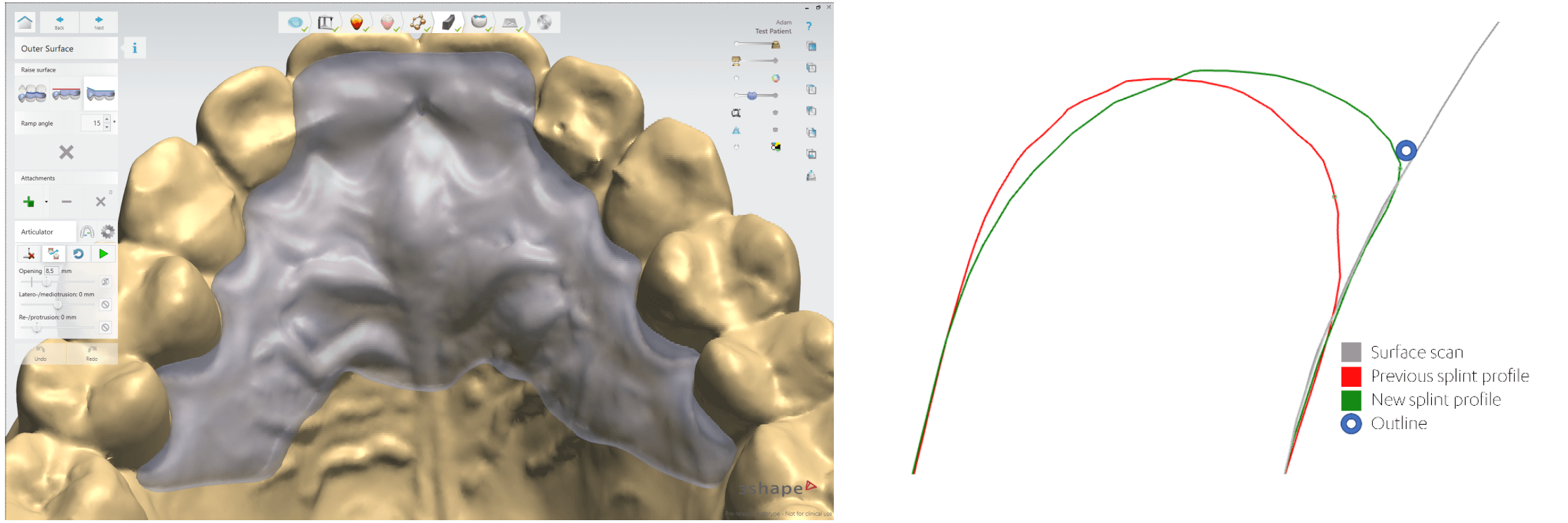 Splint Outline with better control of retention