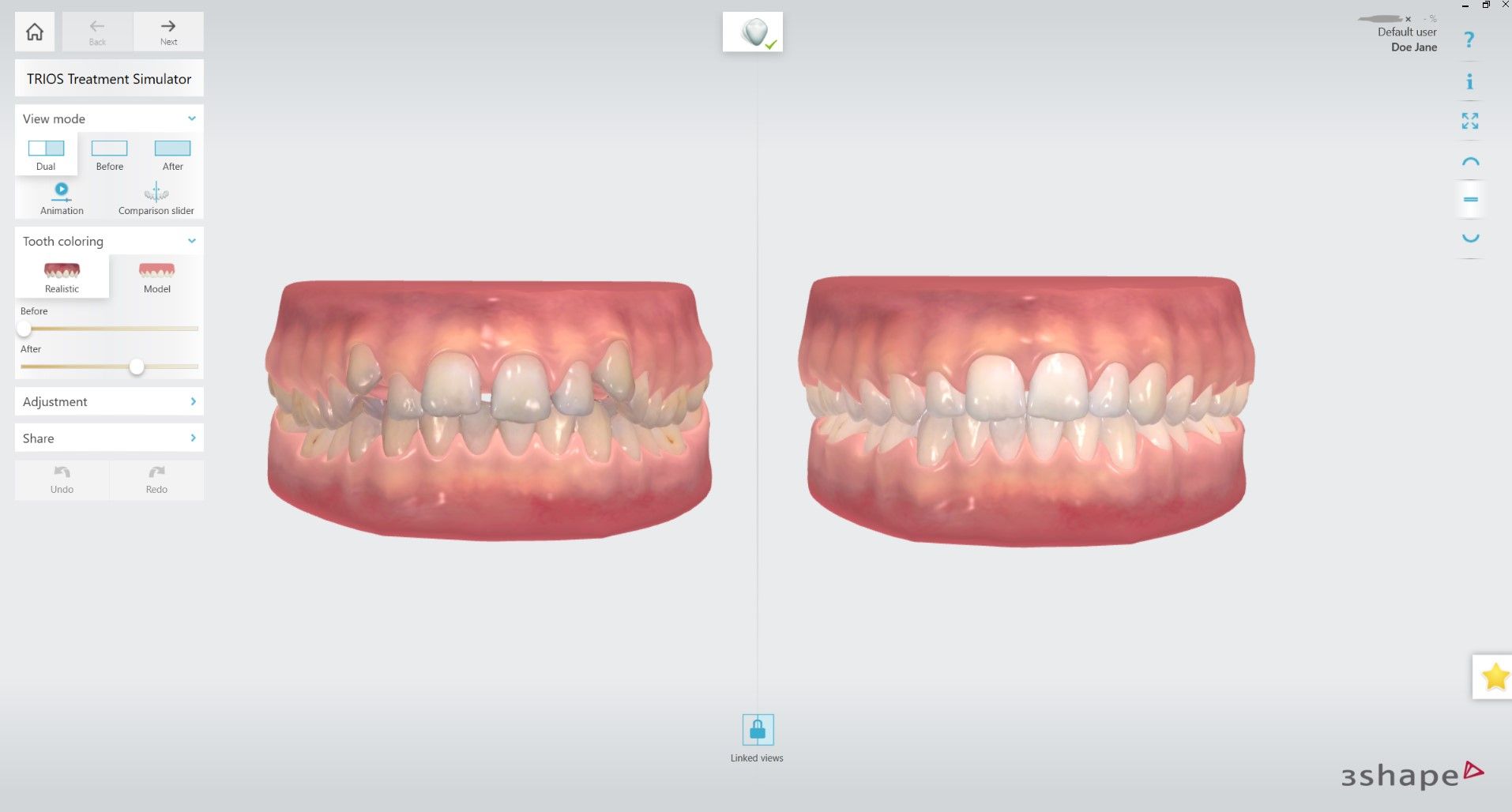 NEW Realistic tooth colors